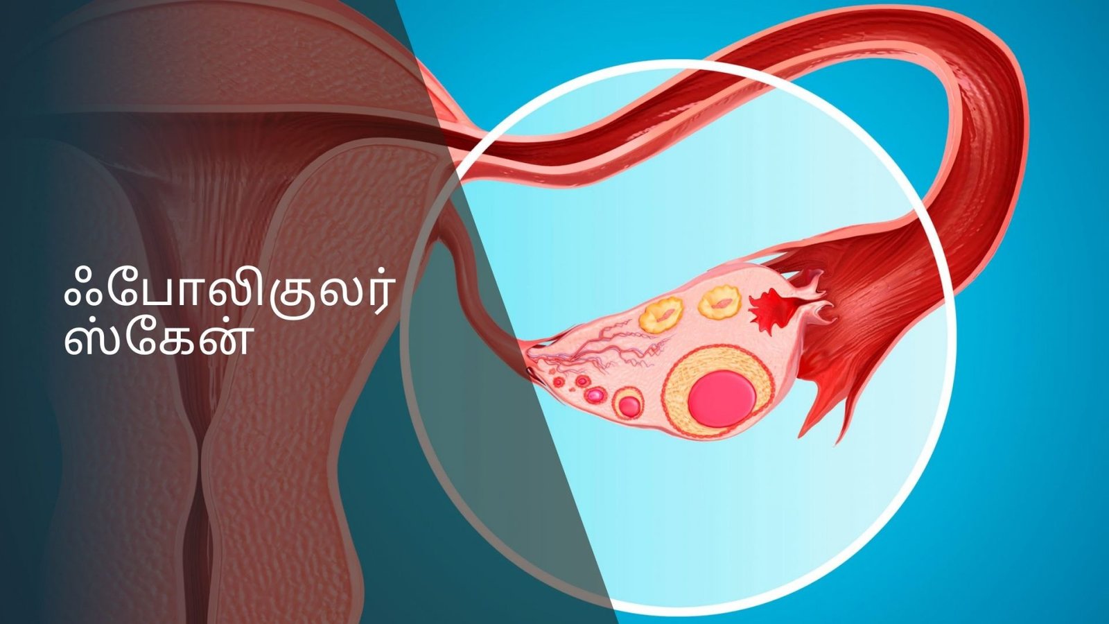 pid-pelvic-inflammatory