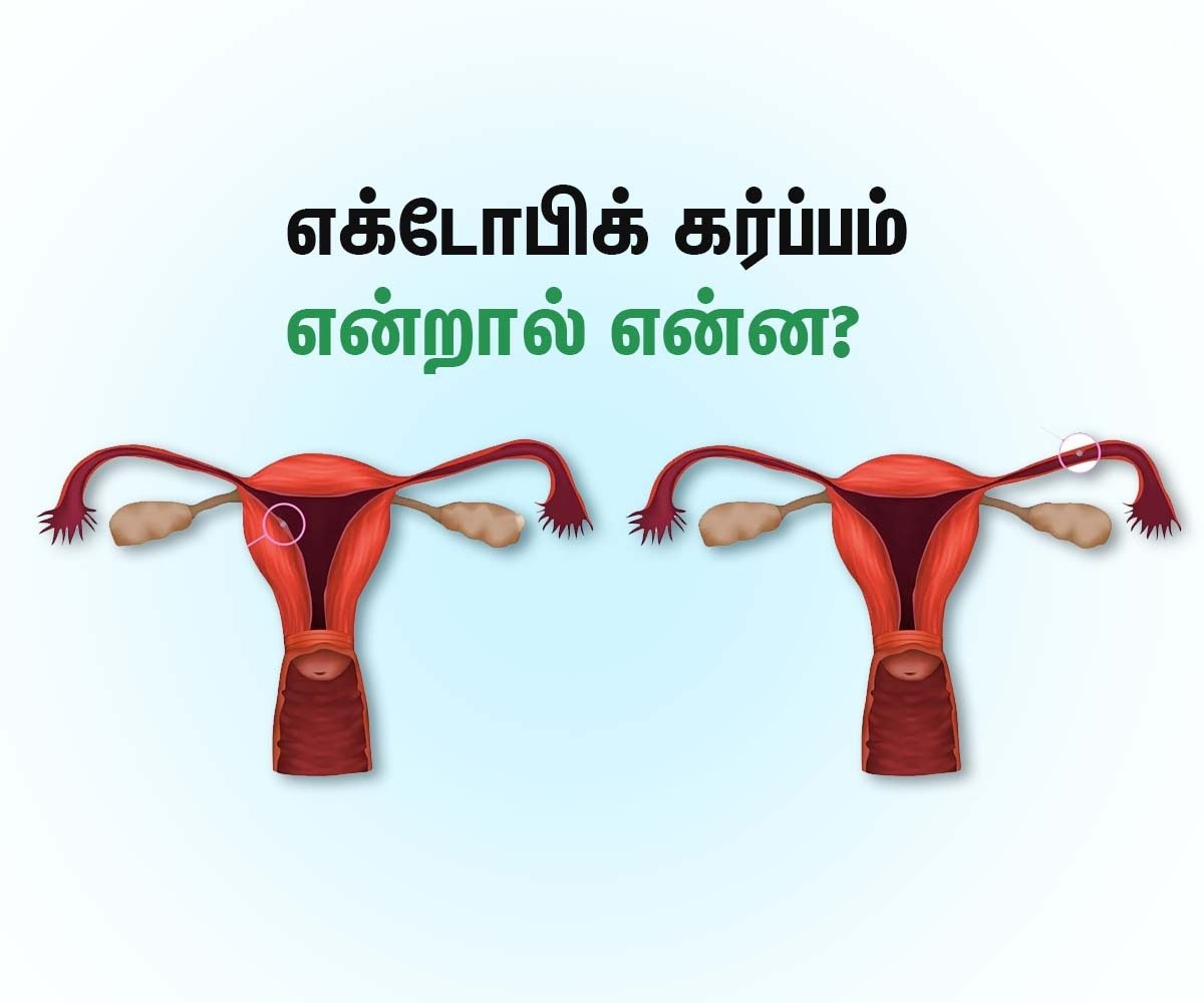 Ectopic Pregnancy