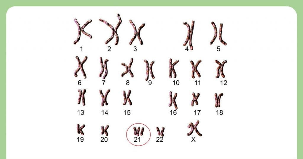 டவுன் சிண்ட்ரோம் பற்றிய முழுமையான விளக்கம்! 3 Trisomy 21 1