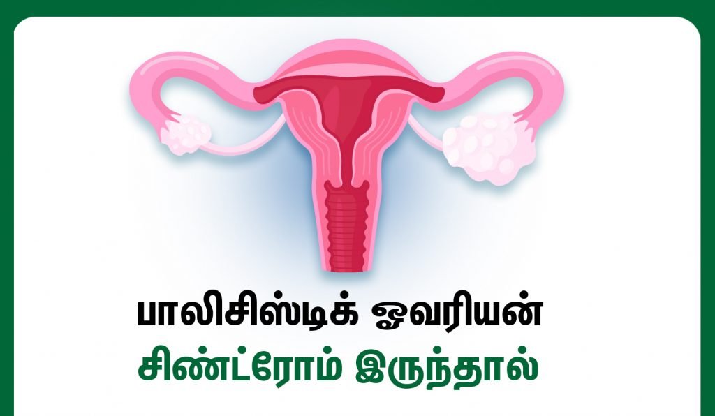 Polycystic Ovary Syndrome-PCOS