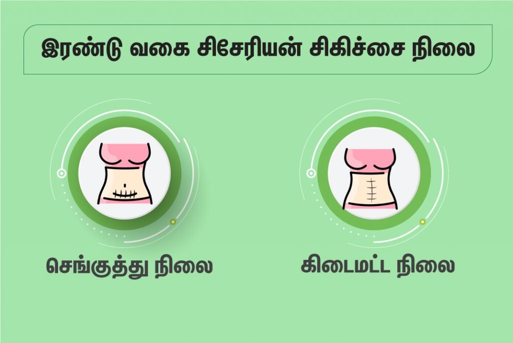 சிசேரியன் வடுக்களை எப்படி அகற்றுவது? 2 Cesarean Section Types