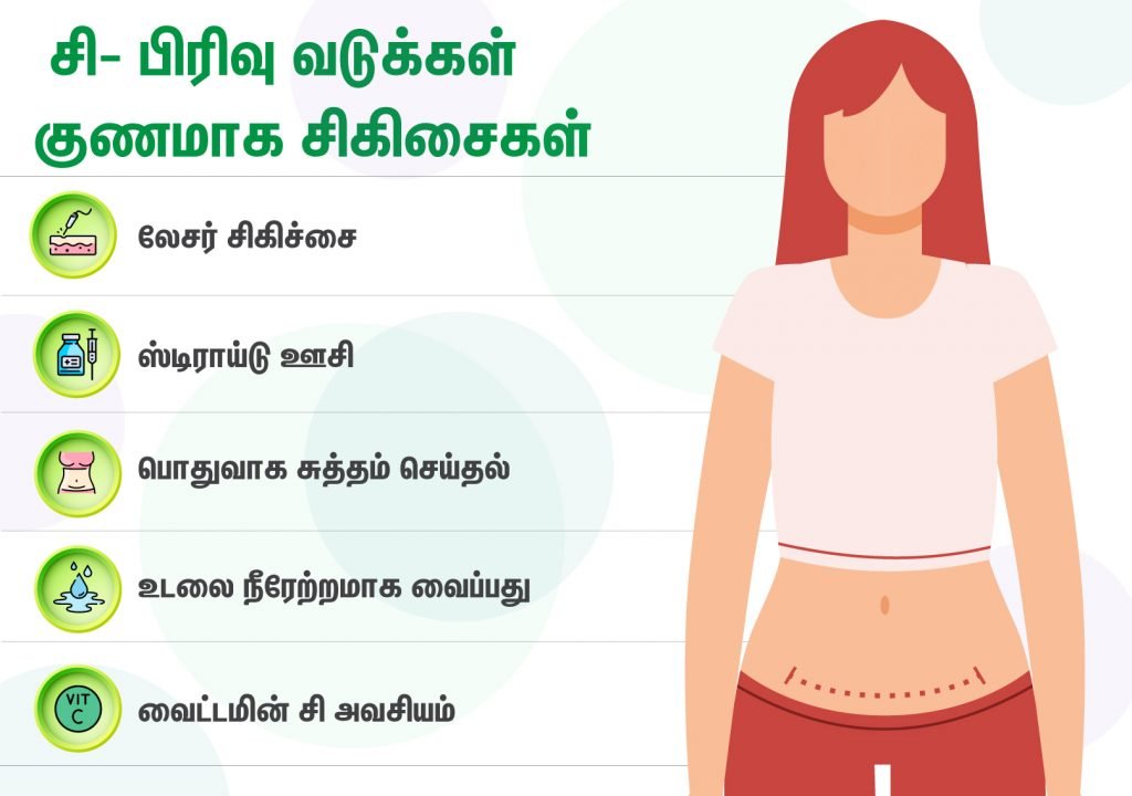சிசேரியன் வடுக்களை எப்படி அகற்றுவது? 4 c-section scars recovery tips