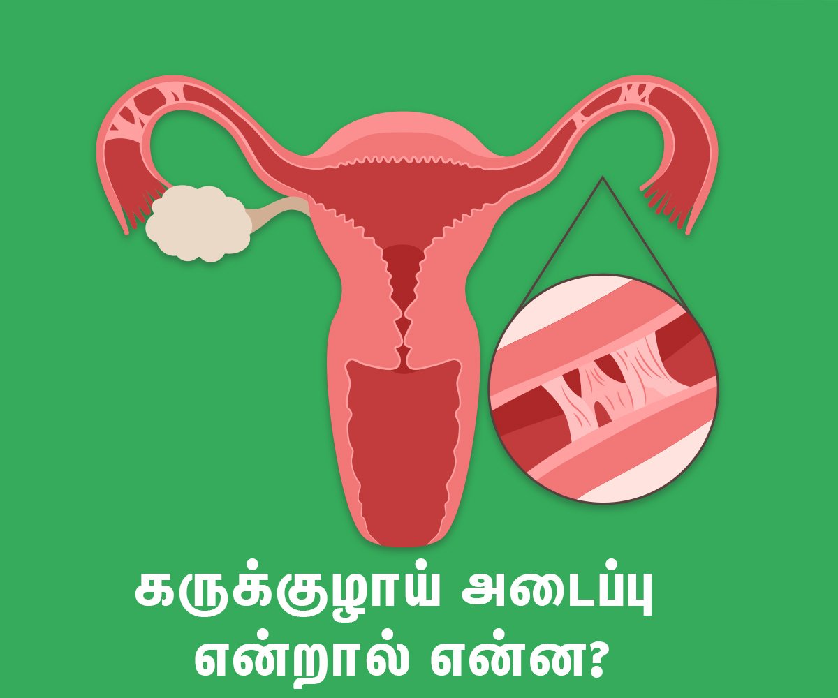 Blocked Fallopian Tubes Affect Infertility