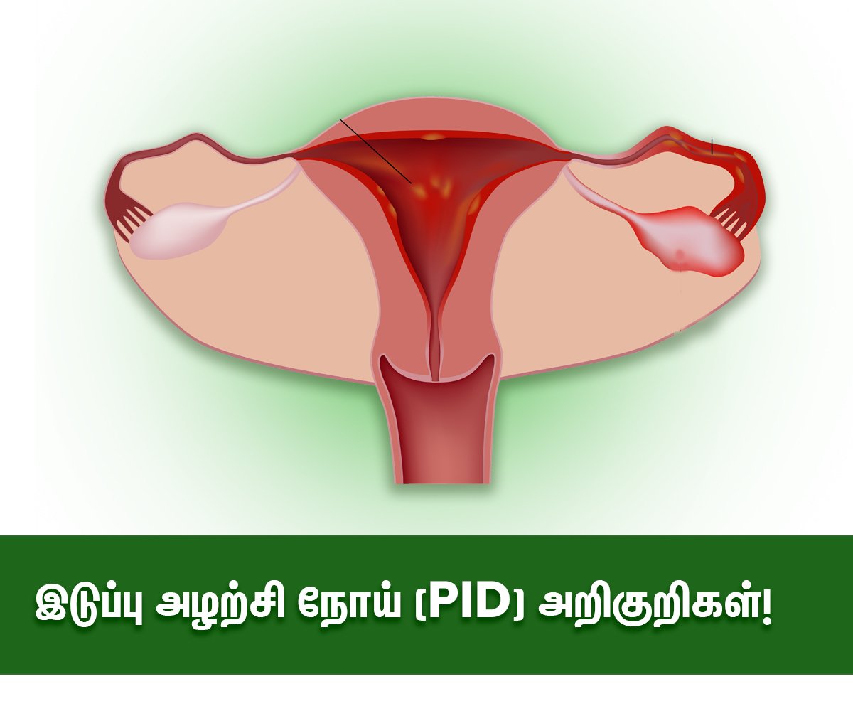 Pelvic inflammatory Disease