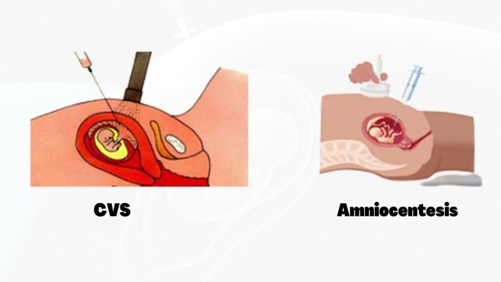 cvs and amniocentesis
