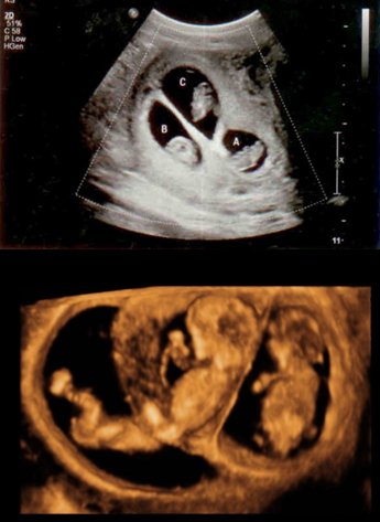 fetal-reduction
